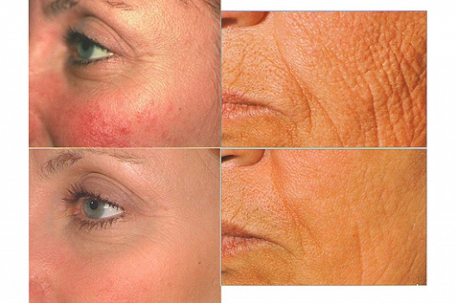 Lāzerterapijas speciālisti konsultēs liepājniekus